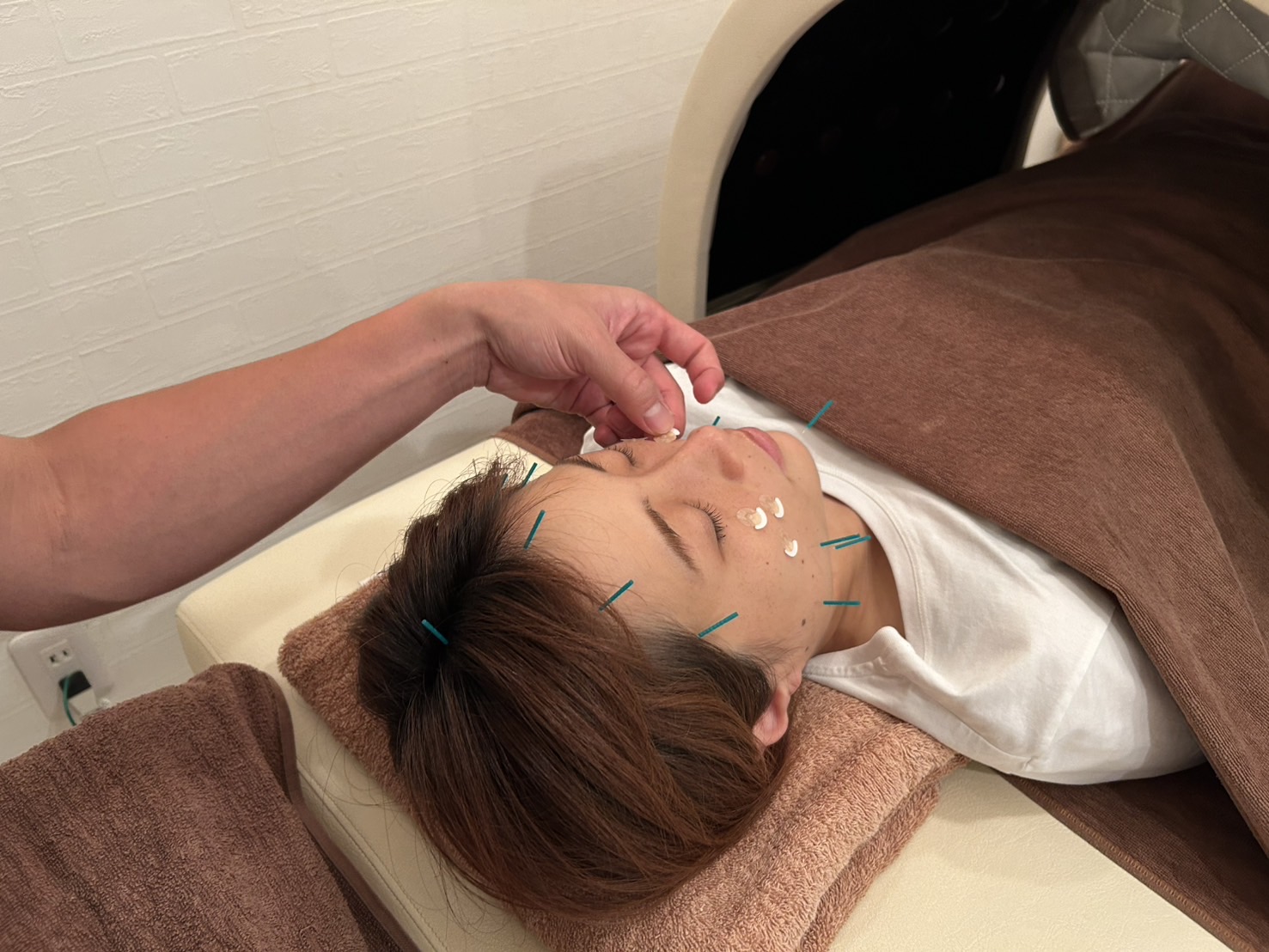 顔に鍼施術
